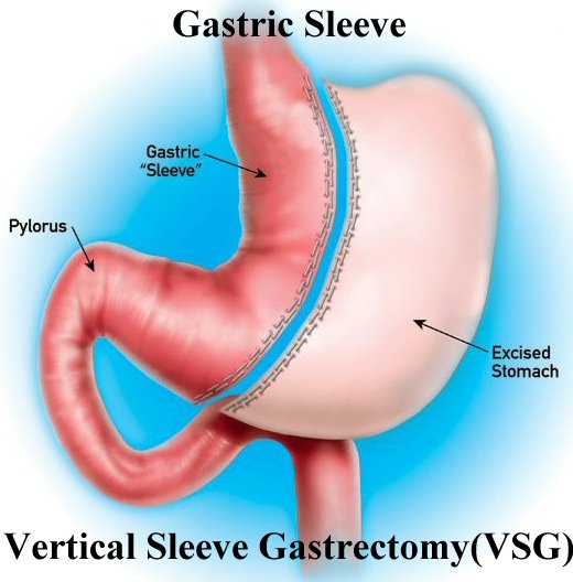 Gastric_Sleeve.jpg