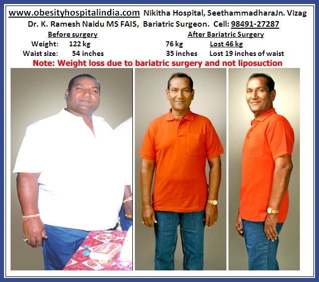 Obesity Weight Loss Surgery Cost